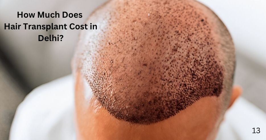 Hair Transplant Cost in India