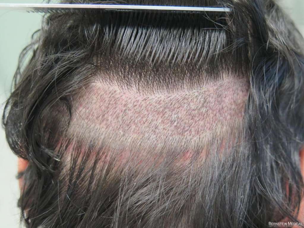 fue hair cenetr in delhi