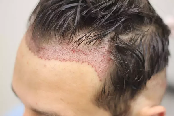 Fue hair transplant in delhi