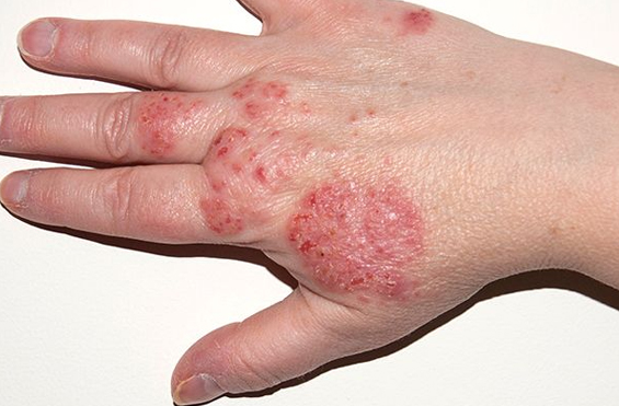 Eczema