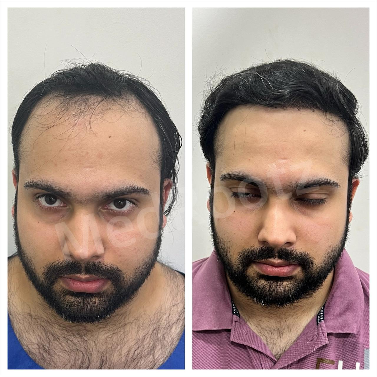 Best hair transplant in India