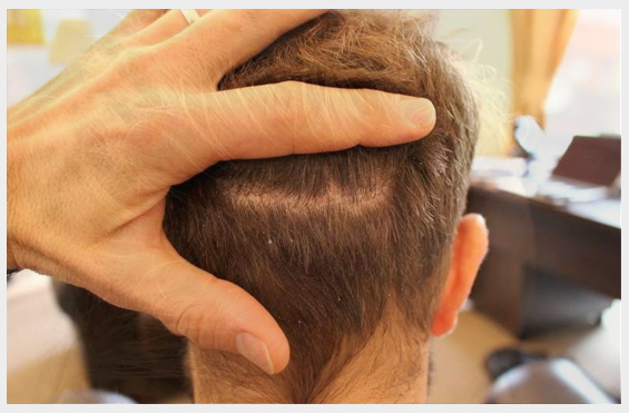 Fue hair transplant in delhi