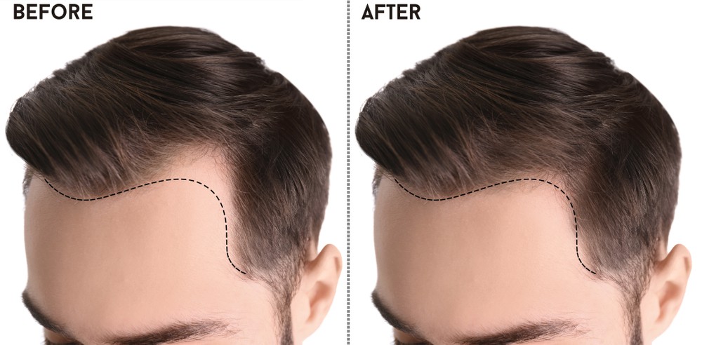 Best Hair Treatment in Delhi