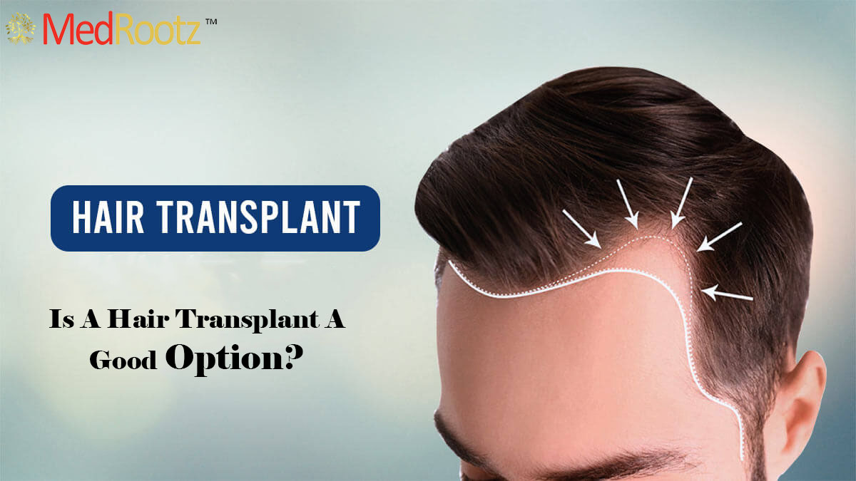 Best Hair Transplant Clinic in Delhi