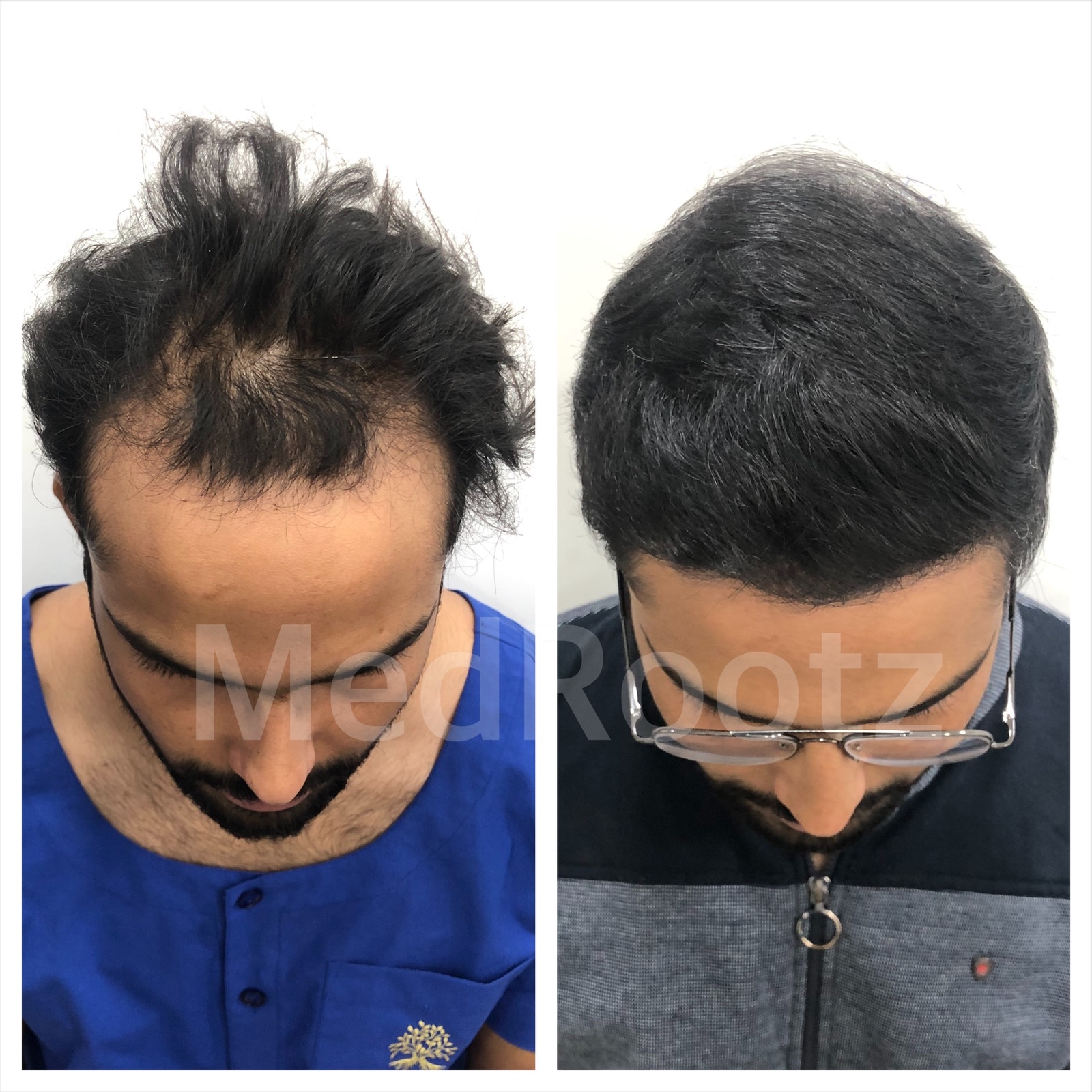 Best Hair Transplant clinic in delhi