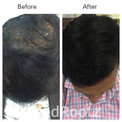 Non-Surgical Voluminous Hair Treatment