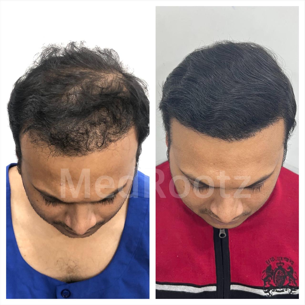 Repair Hair Transplant