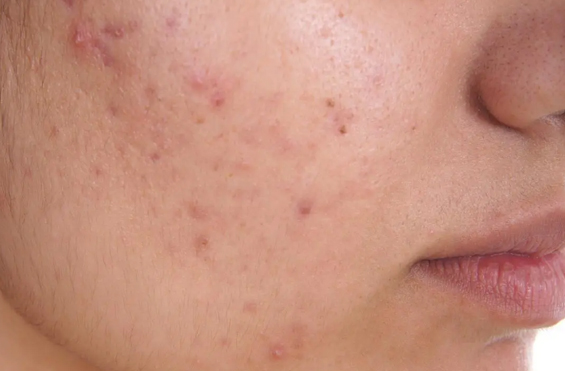 Severe acne