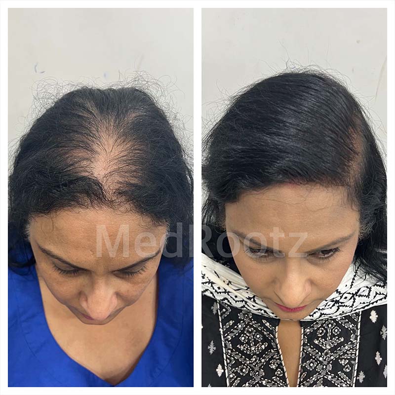 best hair transplant clinic in Delhi