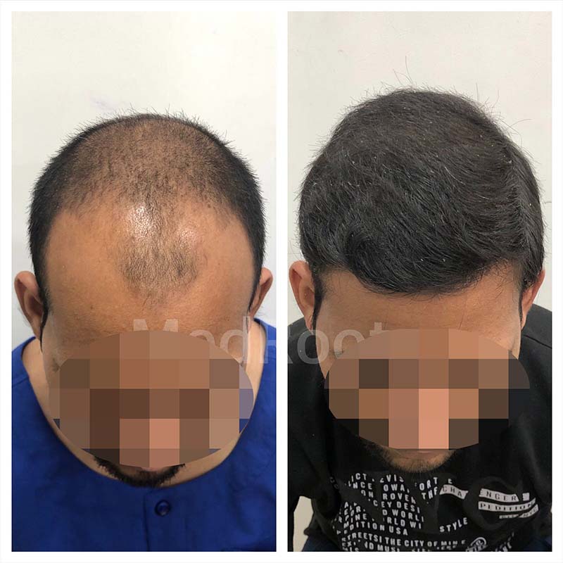 Best Hair Transplant Specialist in Delhi