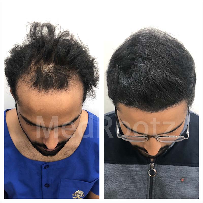 Best Hair Transplant Specialist in Delhi
