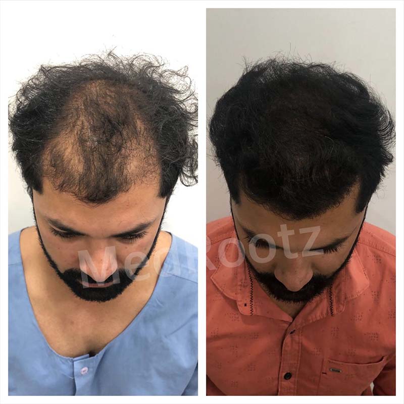 Best Hair Transplant Specialist in Delhi