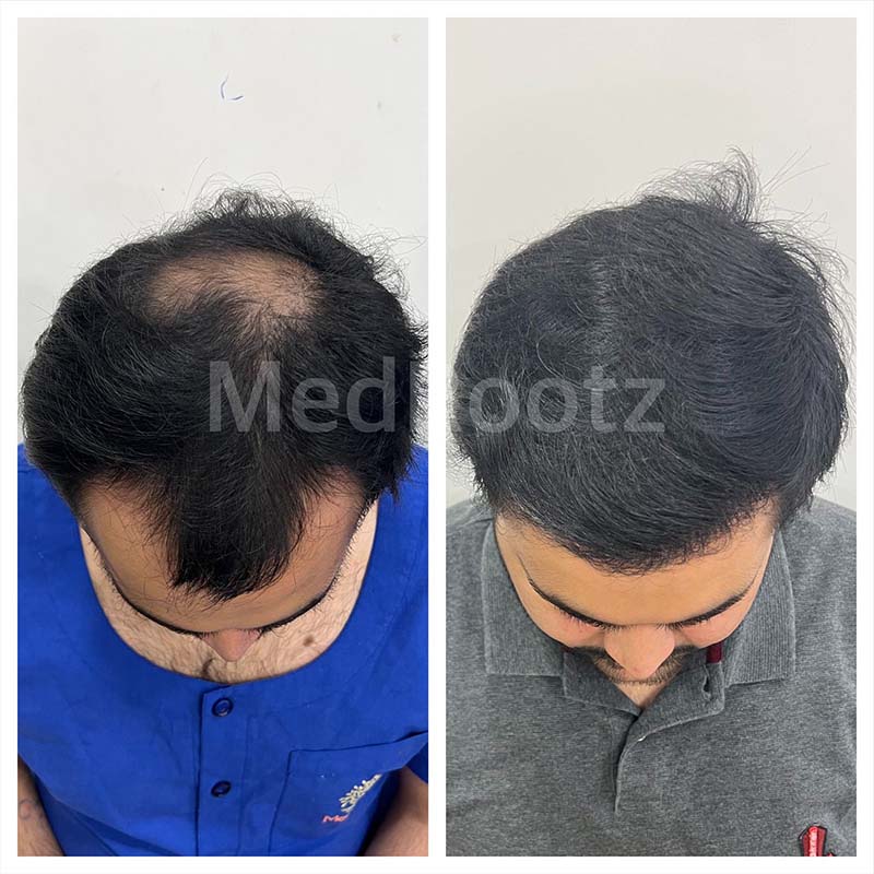 Best Hair Transplant Specialist in Delhi