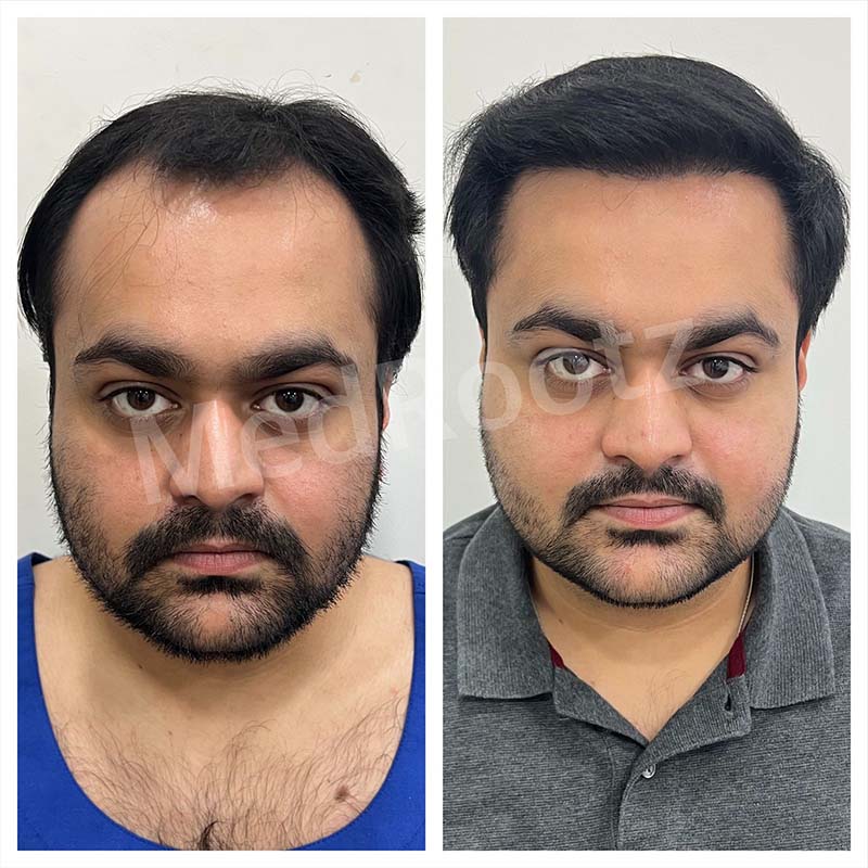 Best Hair Transplant Specialist in Delhi
