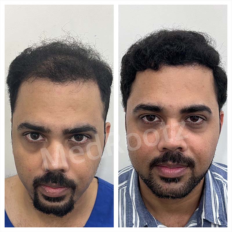 Best Hair Transplant Specialist in Delhi