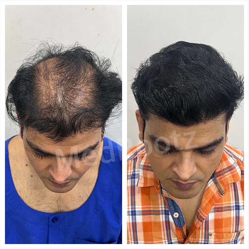Best Hair Transplant Specialist in Delhi