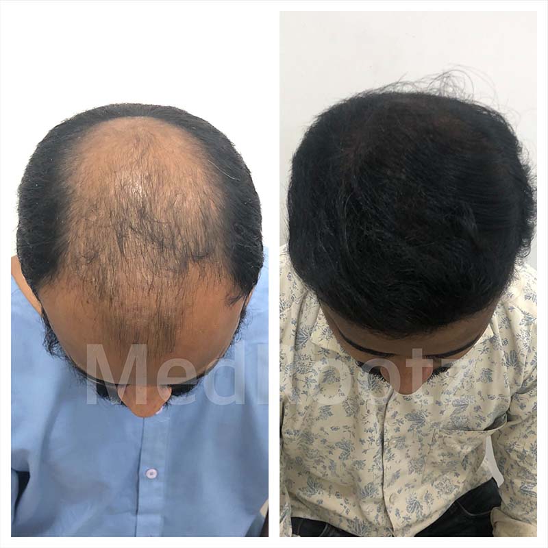 Best Hair Transplant Specialist in Delhi