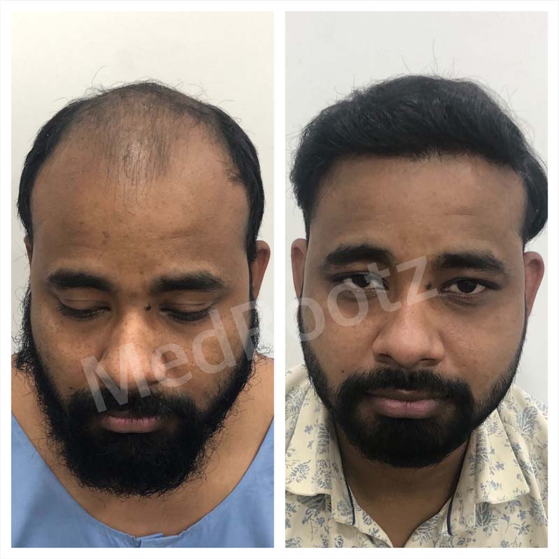 Best Hair Transplant Specialist in Delhi