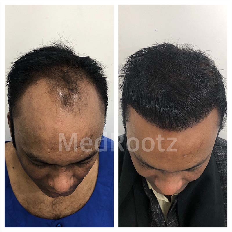 Best hair transplant doctor in delhi