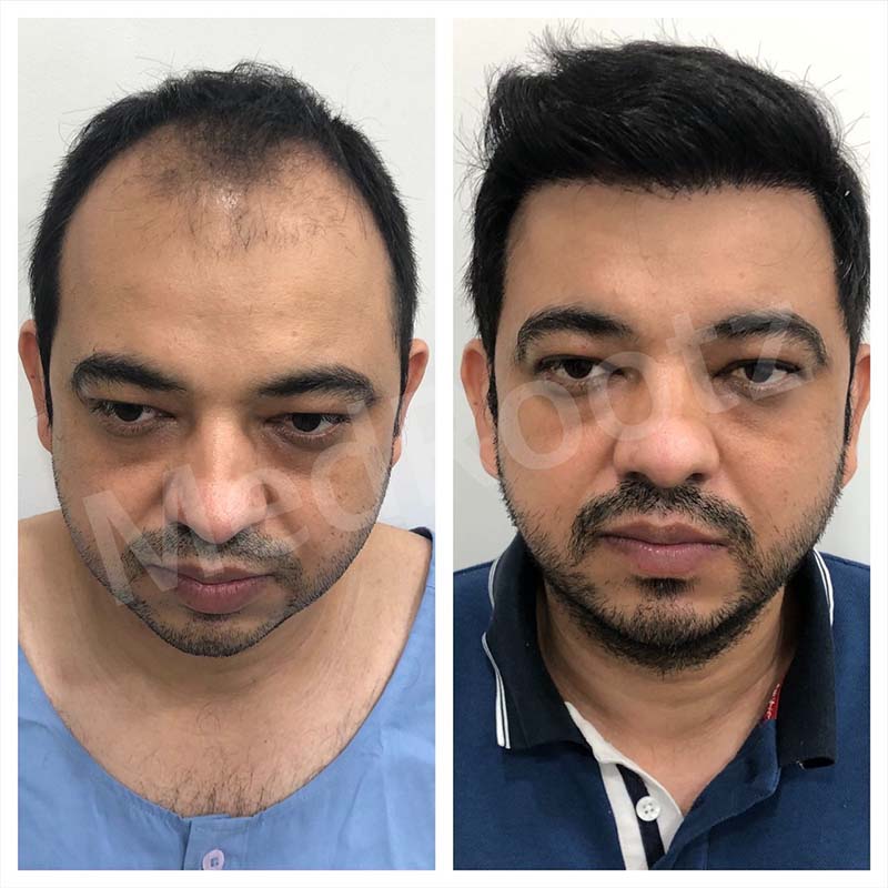Best Hair Transplant Specialist in Delhi
