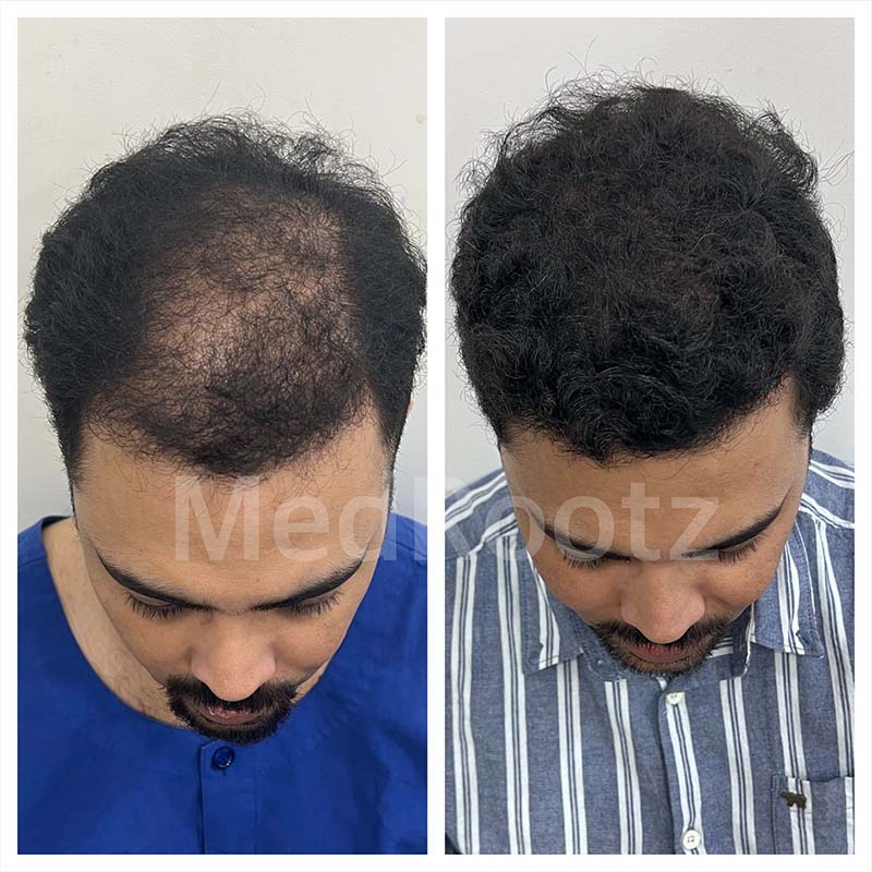 Best Hair Transplant Specialist in Delhi