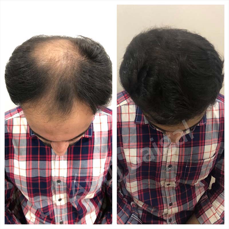 hair Transplant Doctor in New Delhi
