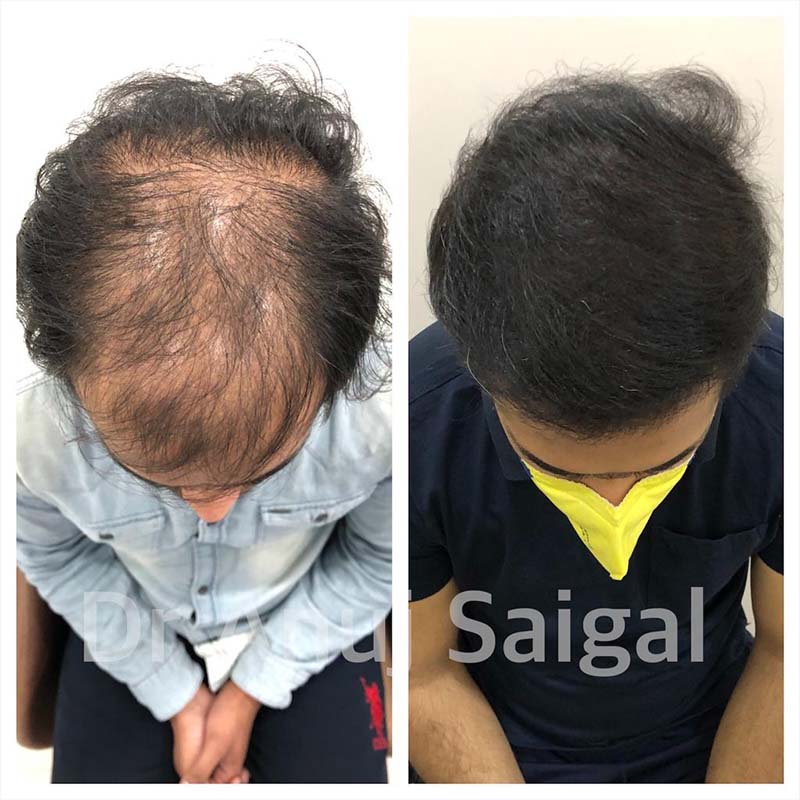 hair Transplant Doctor in New Delhi