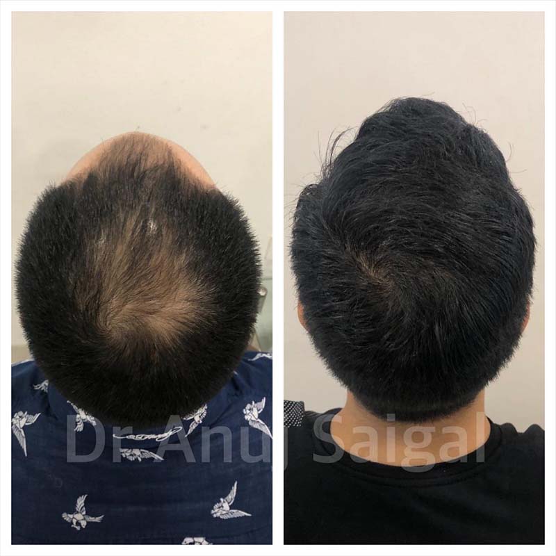 Best Hair Transplant Specialist in Delhi