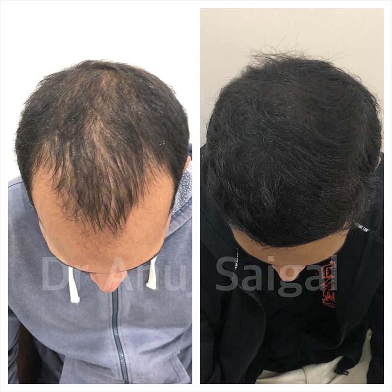 Best Hair Transplant Specialist in Delhi