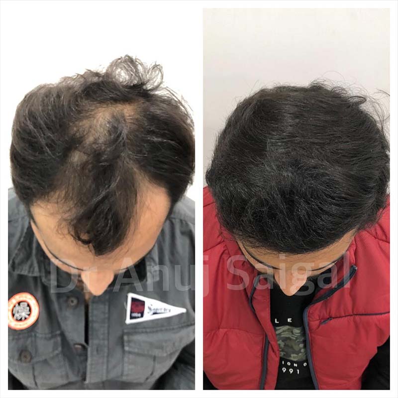 Best Hair Transplant Specialist in Delhi